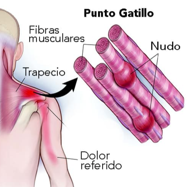 QUIROPRAXIA + FISIOTERAPIA INVASIVA (Incluye Técnica de Punción Seca-Ondas de Choque)