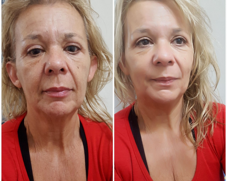 HIFU Facial Completo - efecto lifting sin cirugía (incluye rostro + papada + cuello)