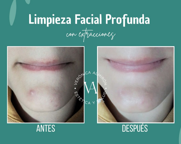 Limpieza Facial Profunda