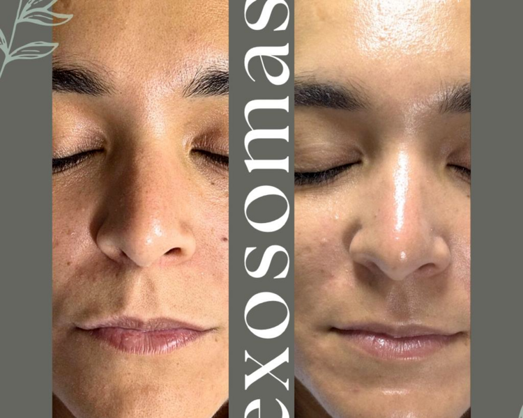 Exosomas Convencional