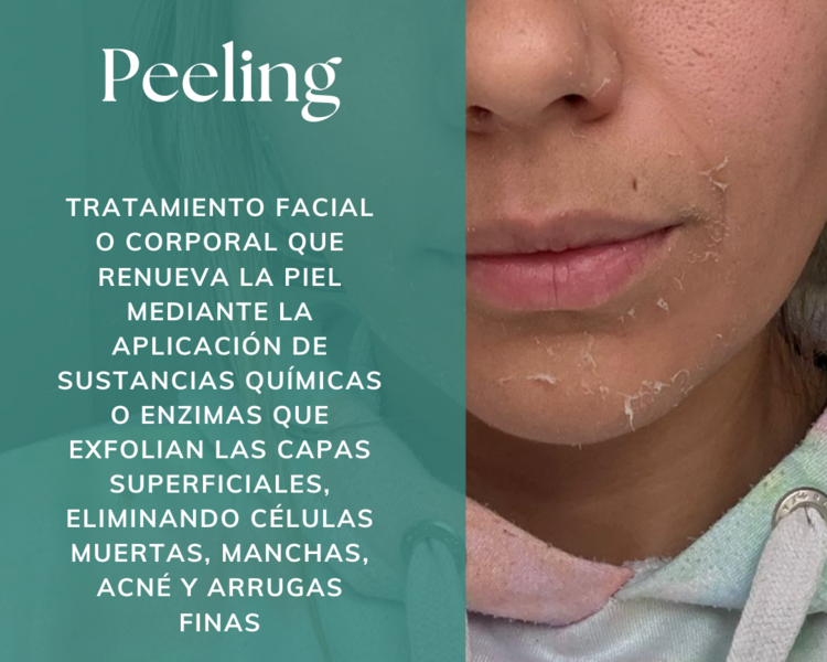 Peeling Medio