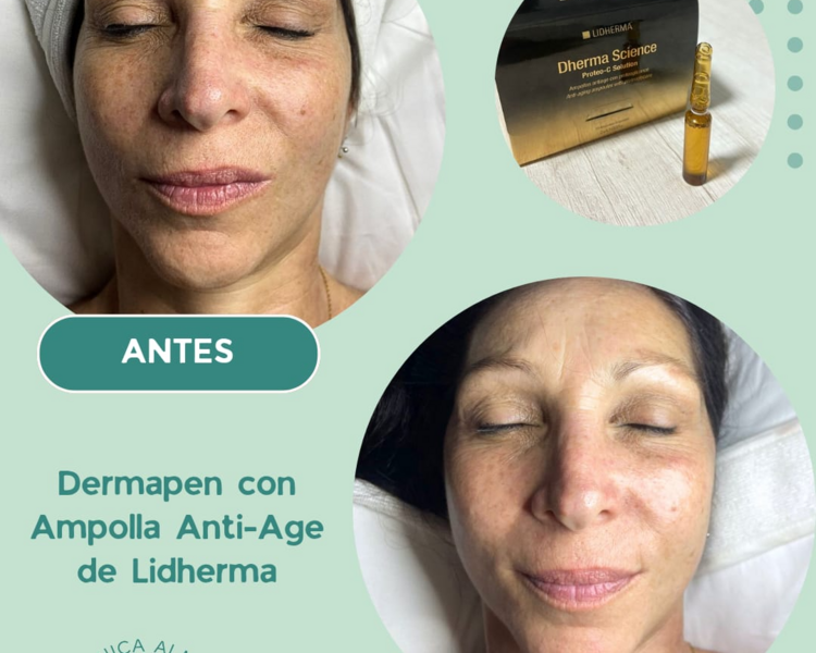 Microneedling (Dermapen)