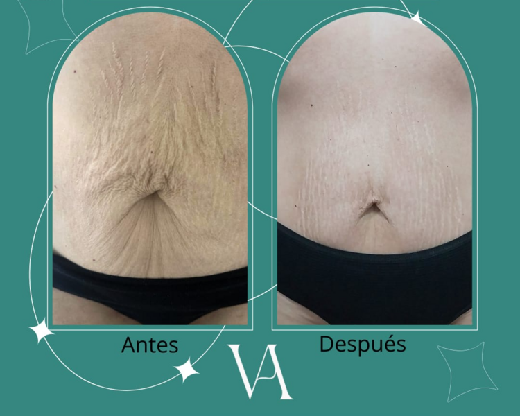 Radio Fraccionada Abdomen
