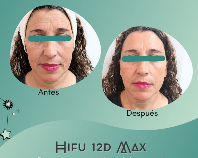 Hifu Rostro