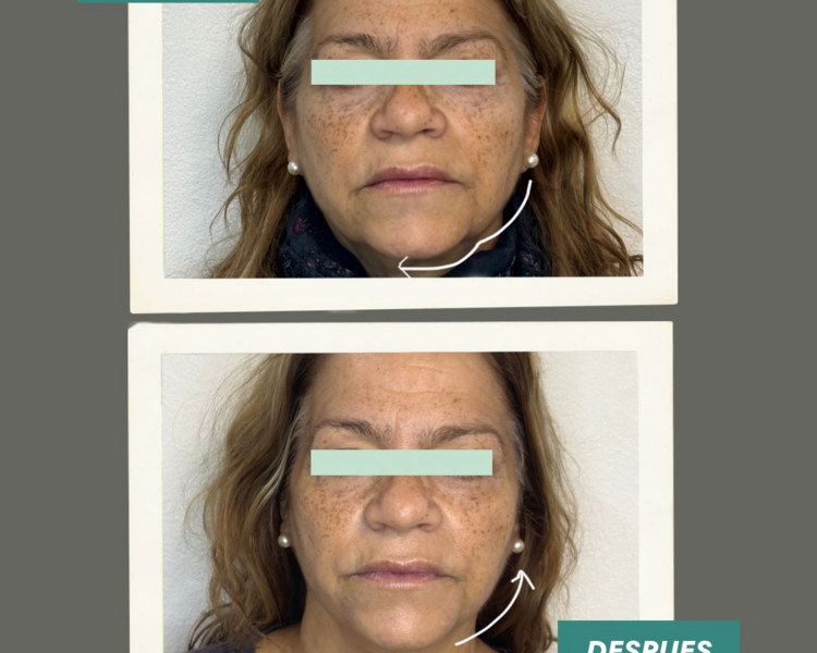 Hifu Rostro + Cuello + Papada + Escote