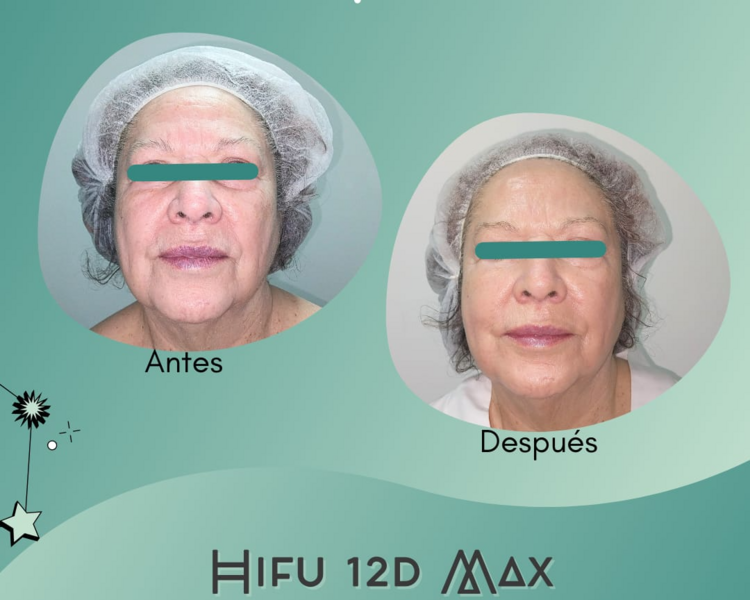 Hifu Rostro + Cuello + Papada + Escote