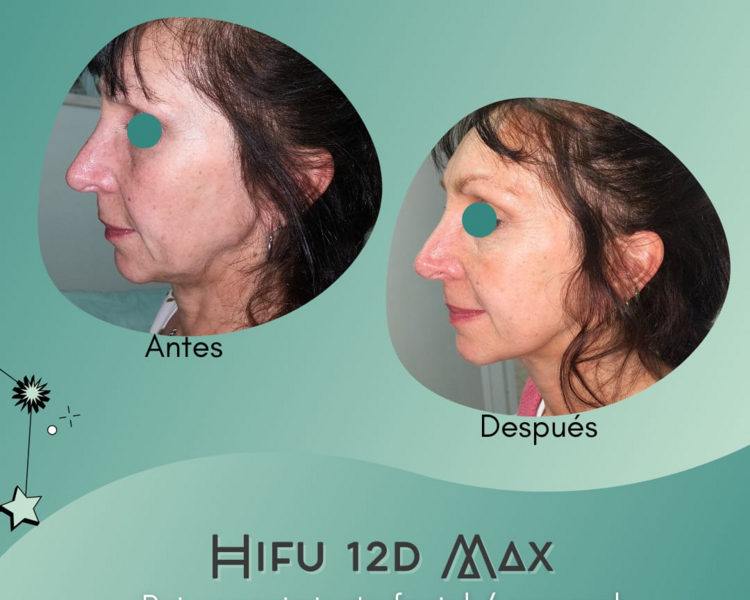 Hifu Rostro + una zona a elección (Cuello, Escote o Papada)