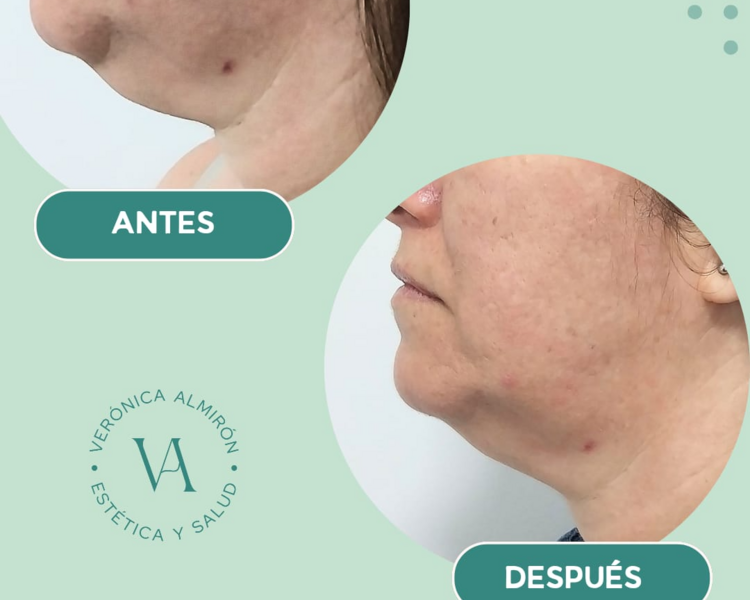 Hifu Rostro + una zona a elección (Cuello, Escote o Papada)