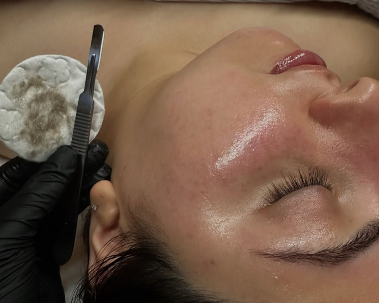 Dermaplaning