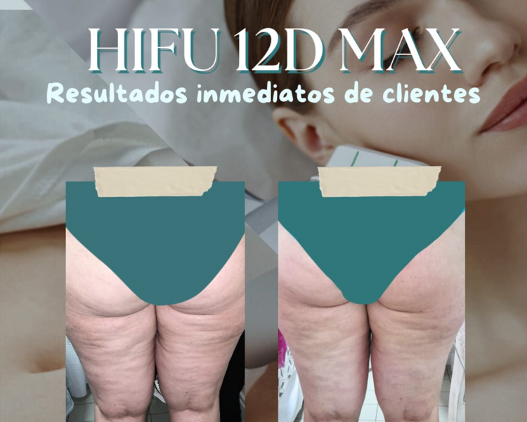 Hifu Glúteos
