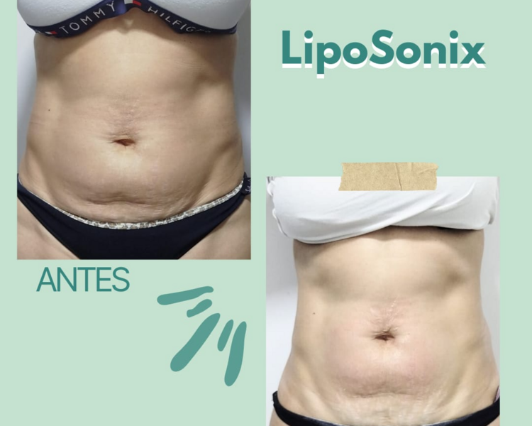 LipoSonix Abdomen Solo