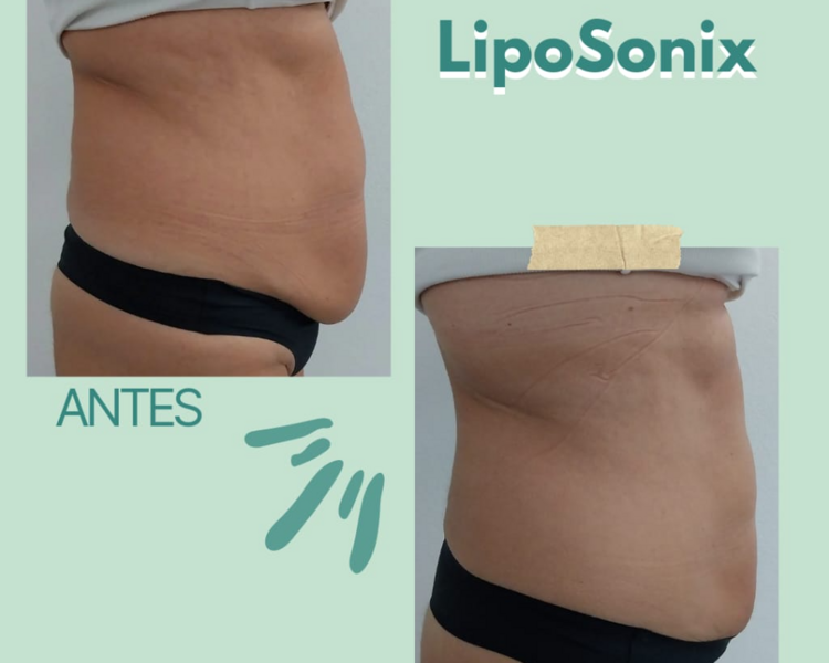 LipoSonix Abdomen Solo
