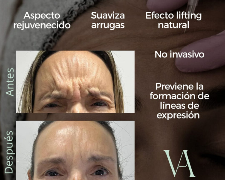Bótox Localizado