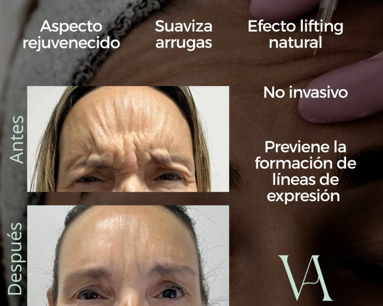 Bótox Localizado