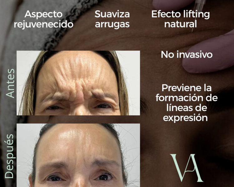 Bótox Tercio Superior