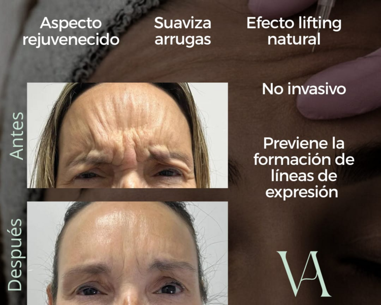 Bótox Tercio Superior