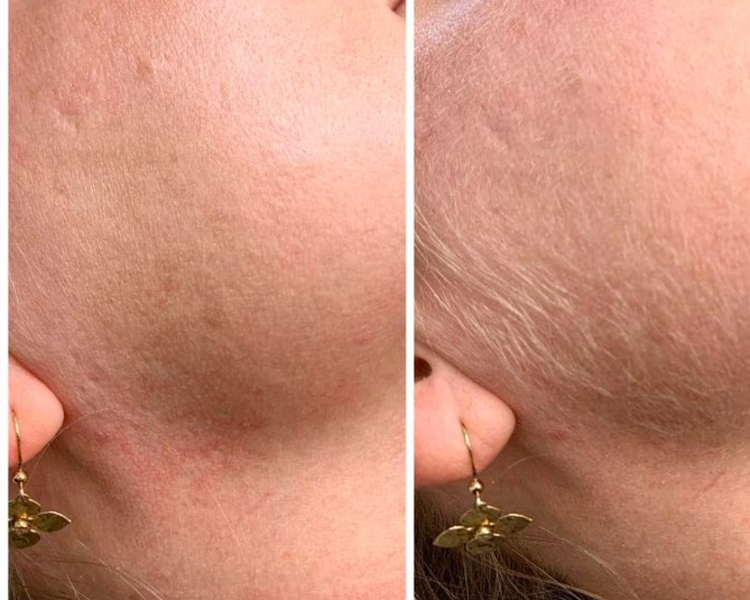 Epilación de Patillas