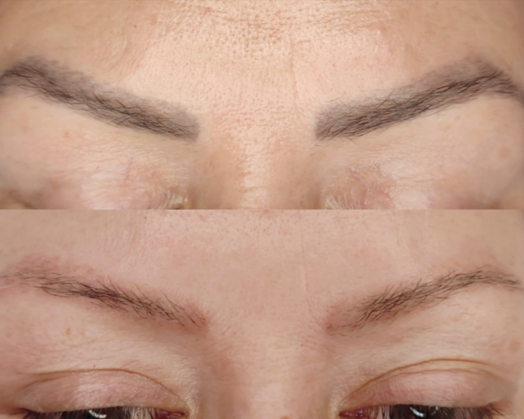 Paquete Remoción Láser Pigmento Cejas (3 Sesiones)