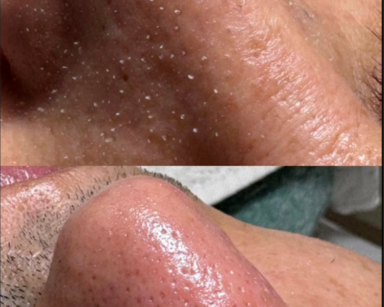 Limpieza con Extracciones