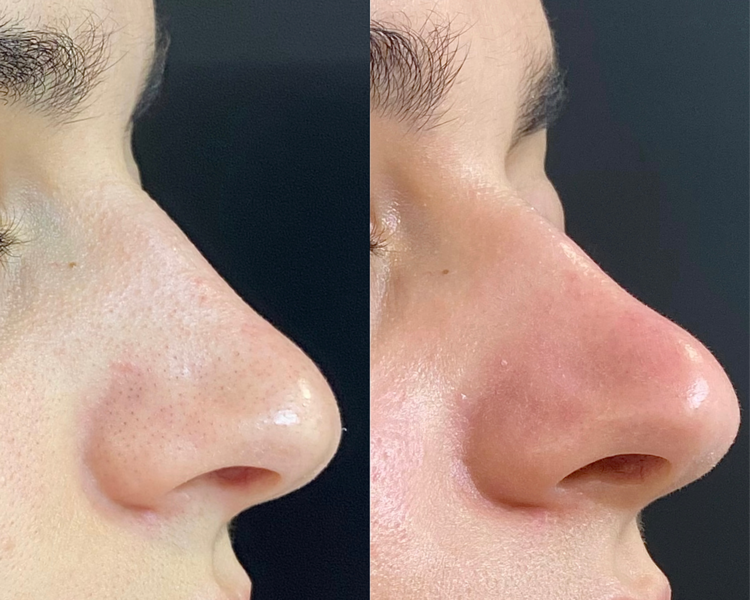 Limpieza facial profunda 