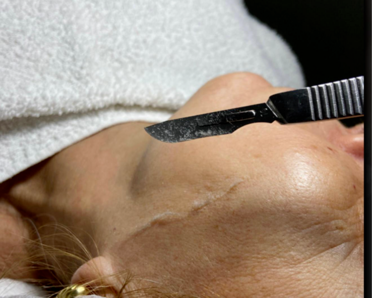 Limpieza con Dermaplaning 