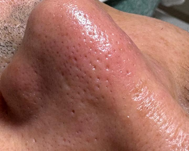 Limpieza facial con extracciones