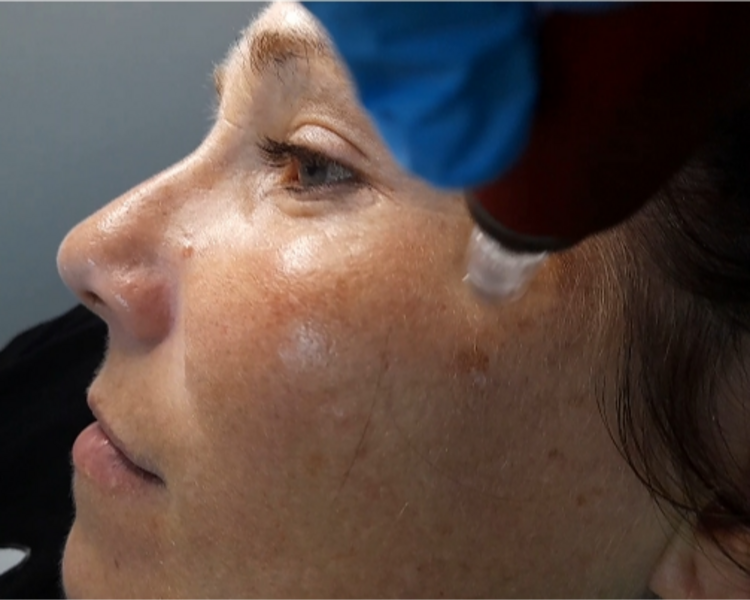 Microneedling (limpieza profunda y aplicación de a. hialurónico con dermapen)