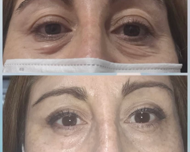 Plasma Rico en Plaquetas (valores desde 90.000)