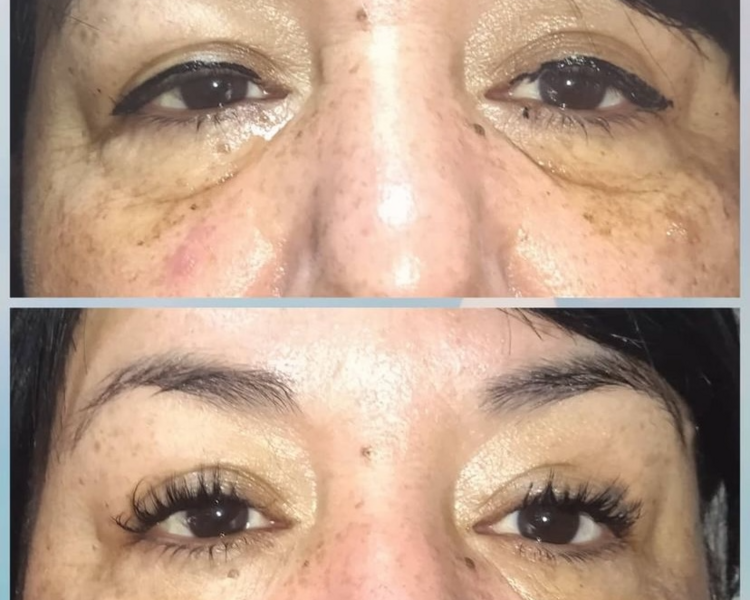 Plasma Rico en Plaquetas (valores desde 90.000)