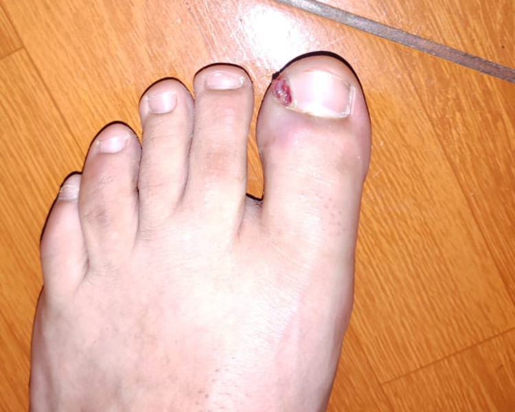 Onicocriptosis con infección + 3 curaciones