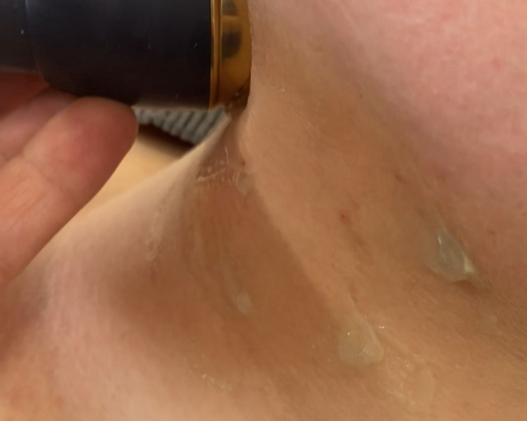 Rehabilitacion Dermatofuncional (zonas pequeñas)