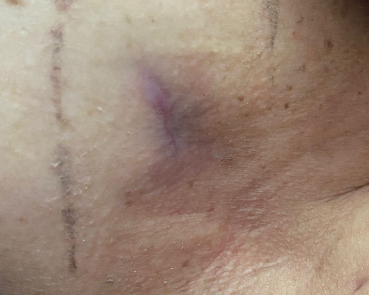 Rehabilitacion Dermatofuncional (zonas pequeñas)