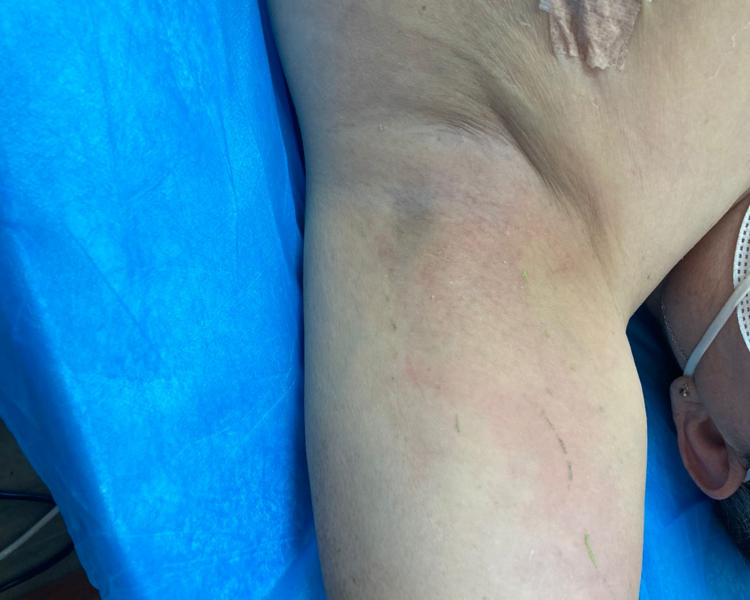 Rehabilitación Oncologica 