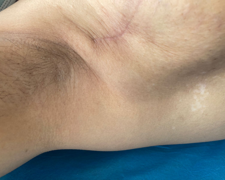 Rehabilitación Oncologica 