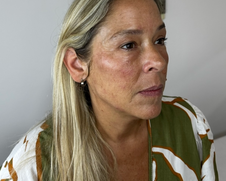 Radiesse - Bioestimulación y definición facial