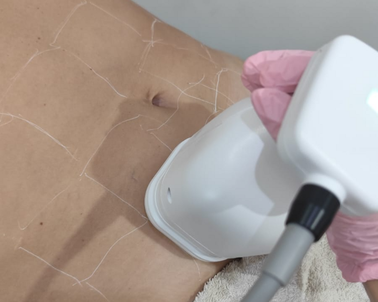 Liposonix 18 + Hifu 12 D Abdomen completo (Coordinar turno vía Whatsaap)