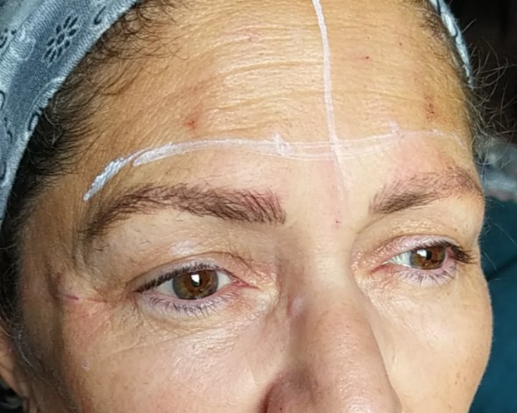 Aplicación de Toxina Botulínica