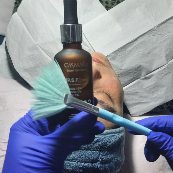 Peeling químico + fototerapia calcio