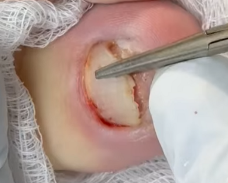 Extracción uña completa