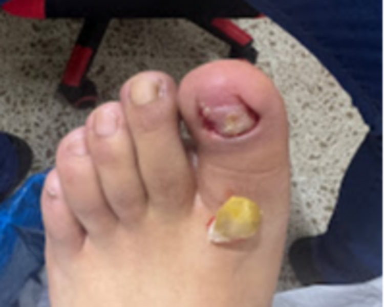 Extracción total de UNA uña (Mano o pie)