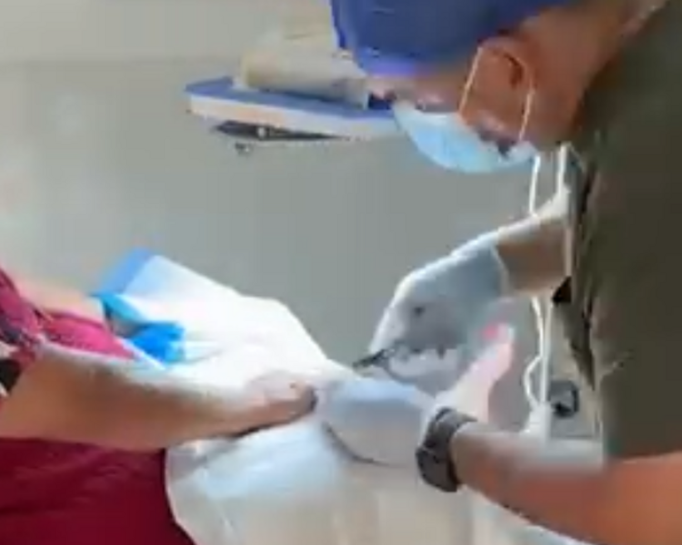 Manicura Onico laser