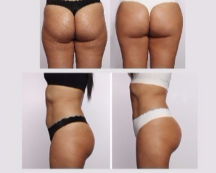 Levantamiento y tonificación de glúteo 10 sesiones 