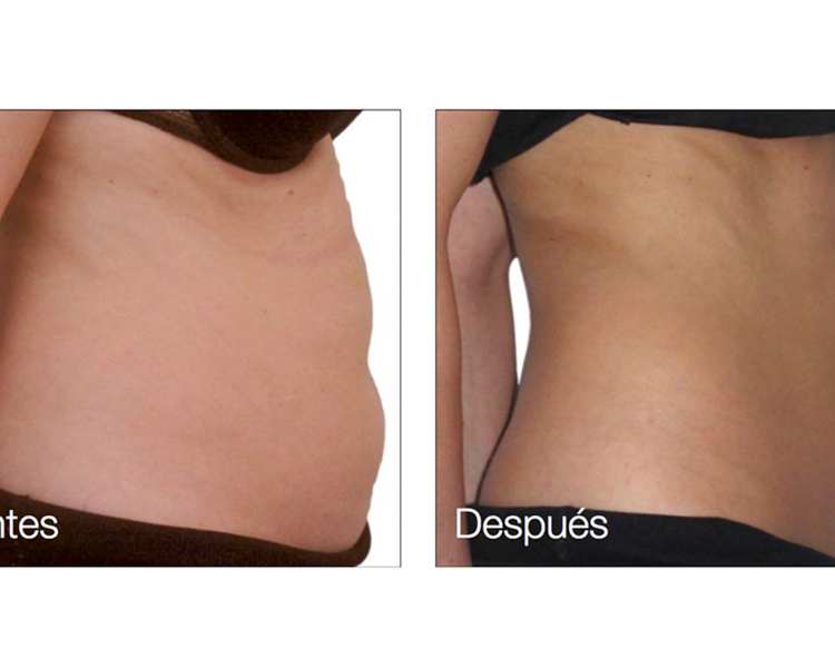 Tratamiento adelgazamiento 10 sesiones