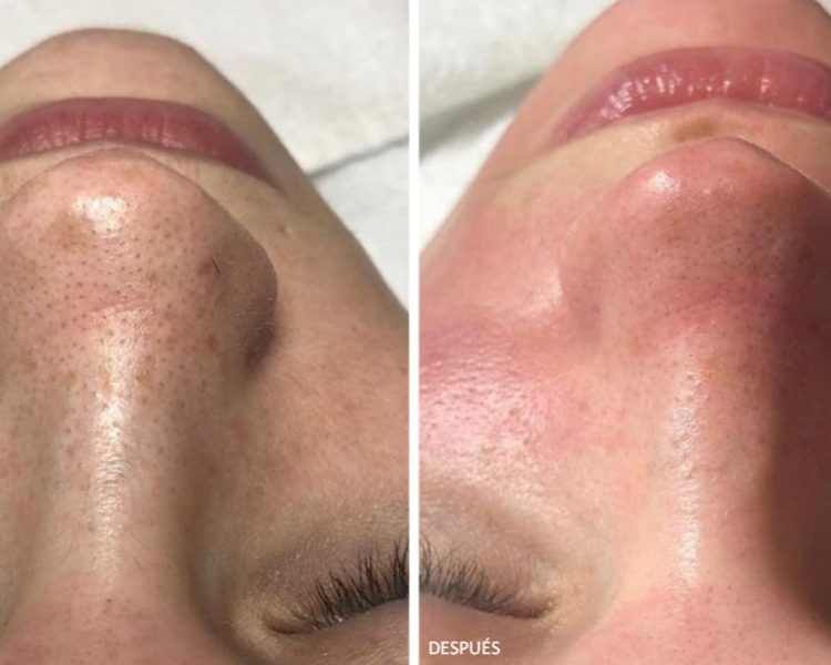 Limpieza facial profunda 