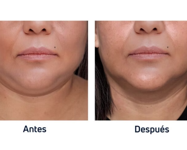 Lipopapada enzimática 