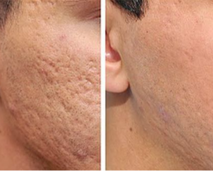 Tratamiento acné, manchas y cicatrices  8 sesiones 