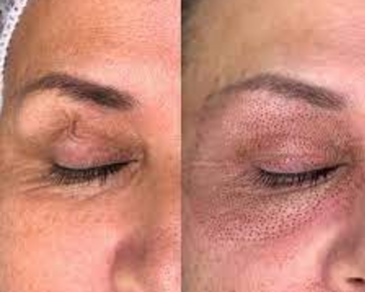 plasma pen ( fibroblast) blefaroplastia sin cirugia 