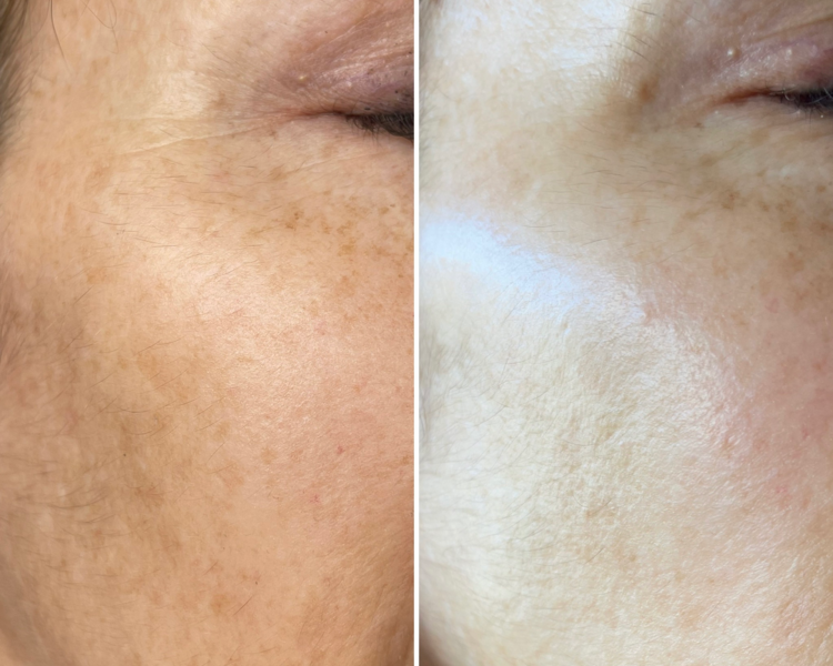 Peeling facial