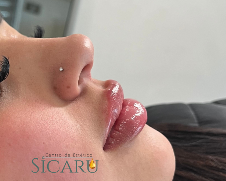 Labios aumento y definición 