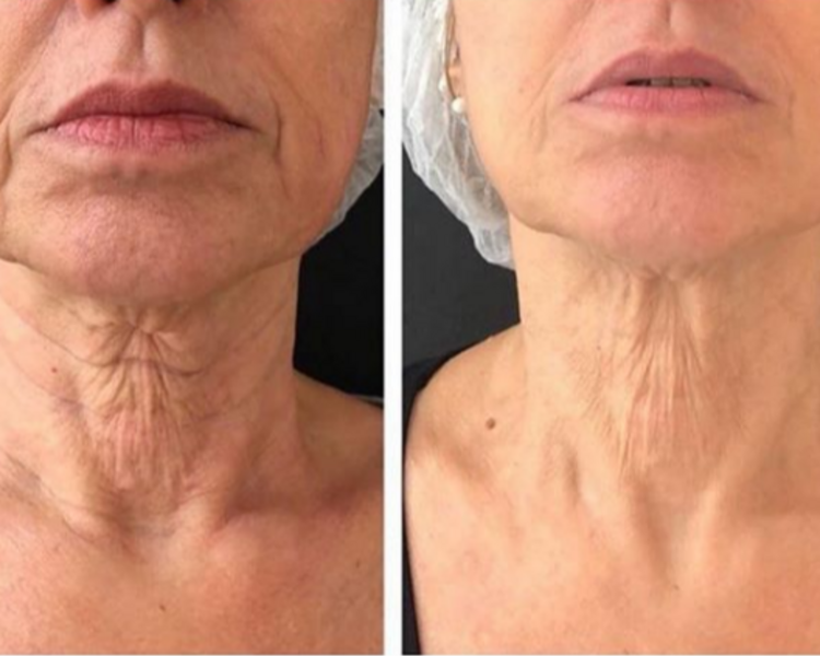 🔹 HIFU Rostro Completo + Cuello + Papada + Escote